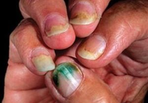 unhealthy fingernails