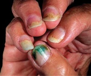 unhealthy fingernails